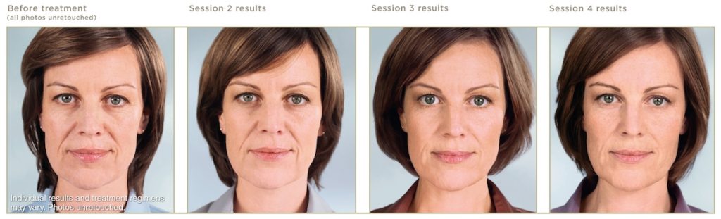 Before and after Sculptra treatments