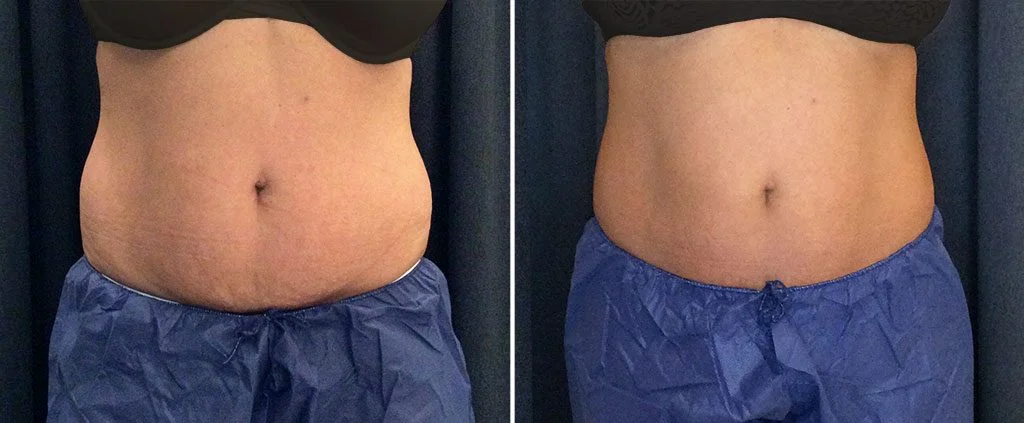 CoolSculpting Westchester for Stubborn Belly Fat