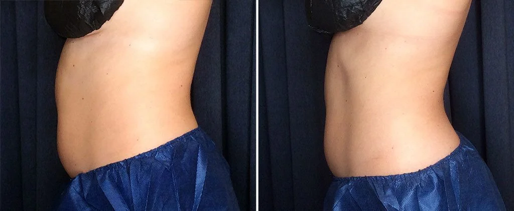 CoolSculpting vs. Lipo: Which is Better? [Price, Downtime, Pain] 
