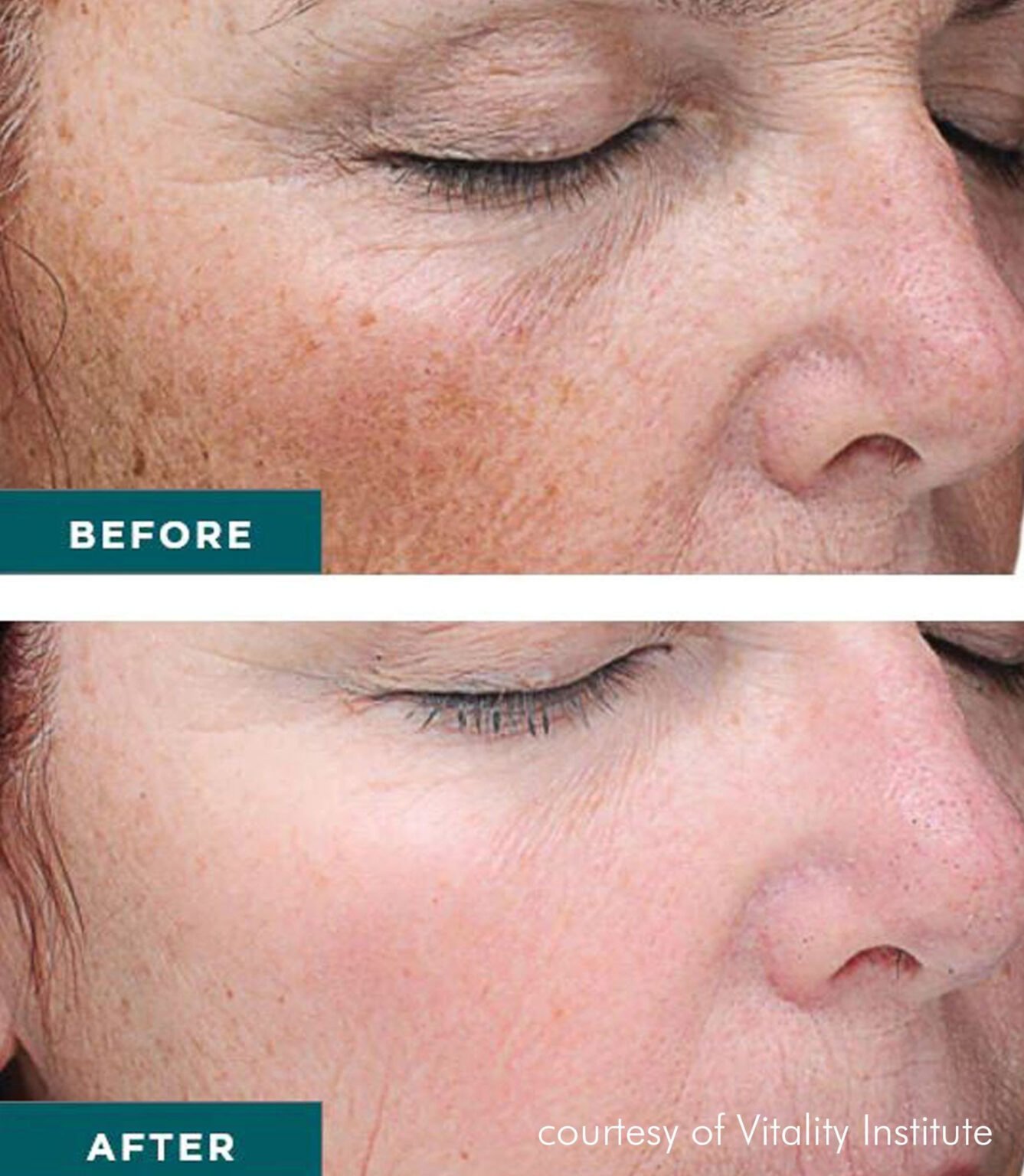 VI Peel - Chemical Peels - Kalos Medical Spa, Fort Worth