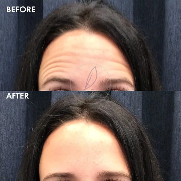 Before and after Botox injections to treat dynamic forehead wrinkles 