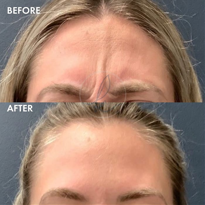 Before and after Botox injections to treat glabellar lines between the brows 