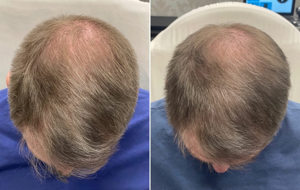 Before and after Fort Worth hair restoration treatment