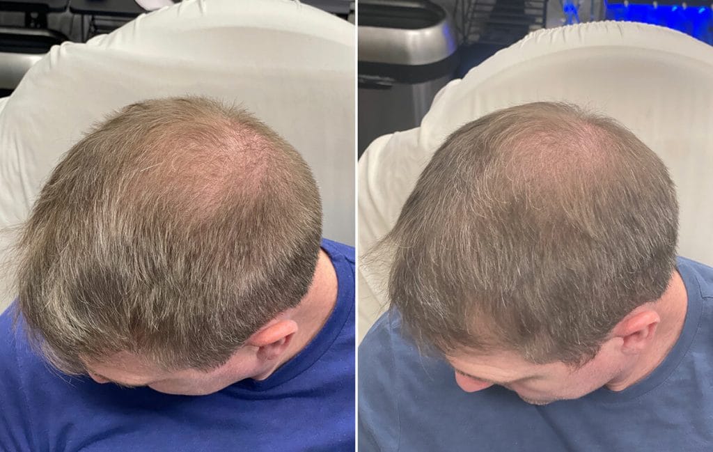 Before and after Fort Worth hair restoration treatment