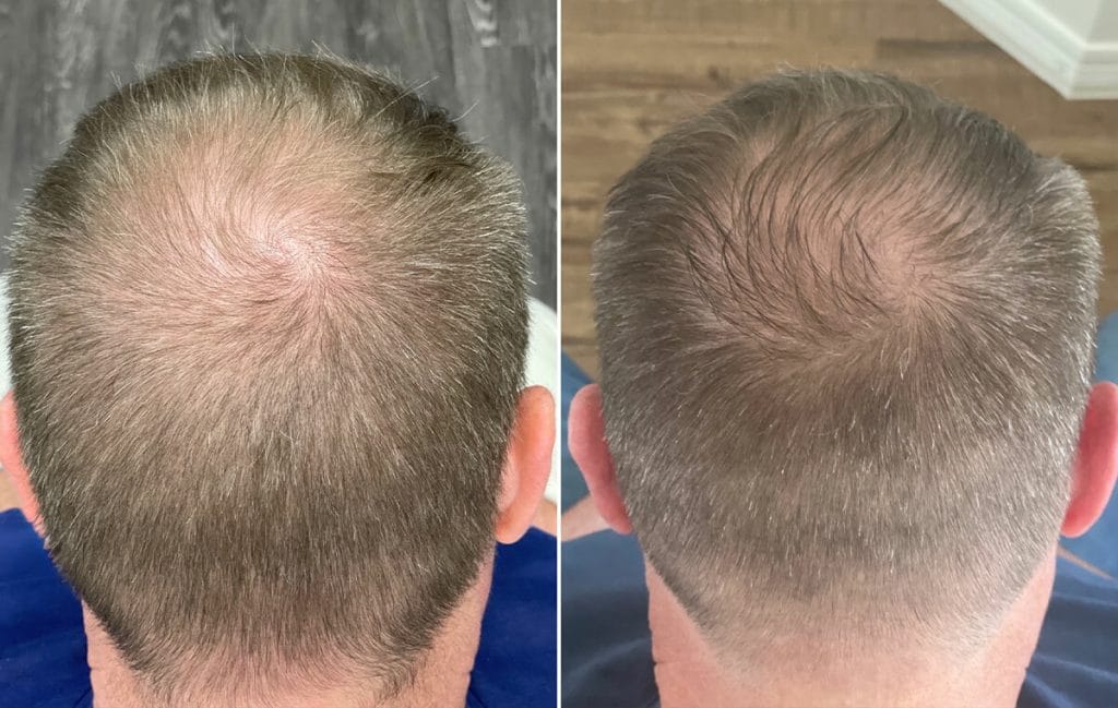 Before and after Fort Worth hair restoration treatment