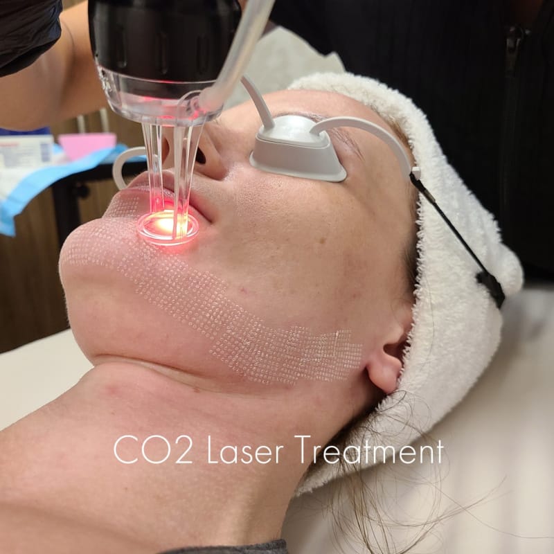 Close up of a CO2 laser skin resurfacing treatment at a Fort Worth medical spa